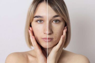 Before and after image of woman with acne issues for article on ingredients for skincare formulations for acne