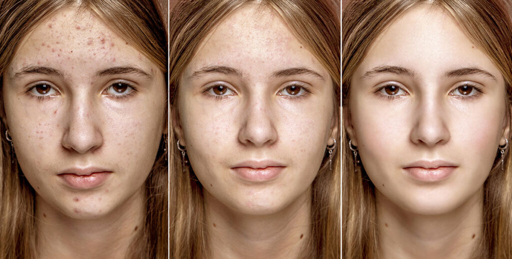 Teenage girl before and after acne and comedones treatment. Skin problems and their solution. The concept of clean skin in teenagers.